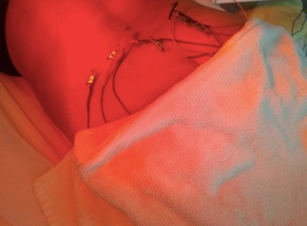 Eletroacupuntura com laser.