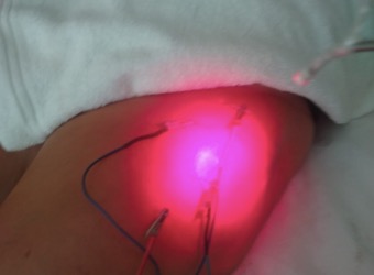 Eletroacupuntura com laser.