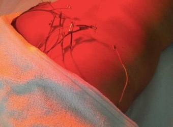 Eletroacupuntura com laser.