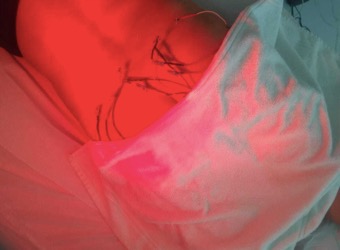 Eletroacupuntura com laser.