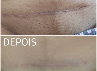 Colocação  de brincos humanizada Elaborado pela medicina Tradicional  chinesa sem perfurar os pontos auriculares  que estão diretamente ligados aos pontos  de acupuntura.